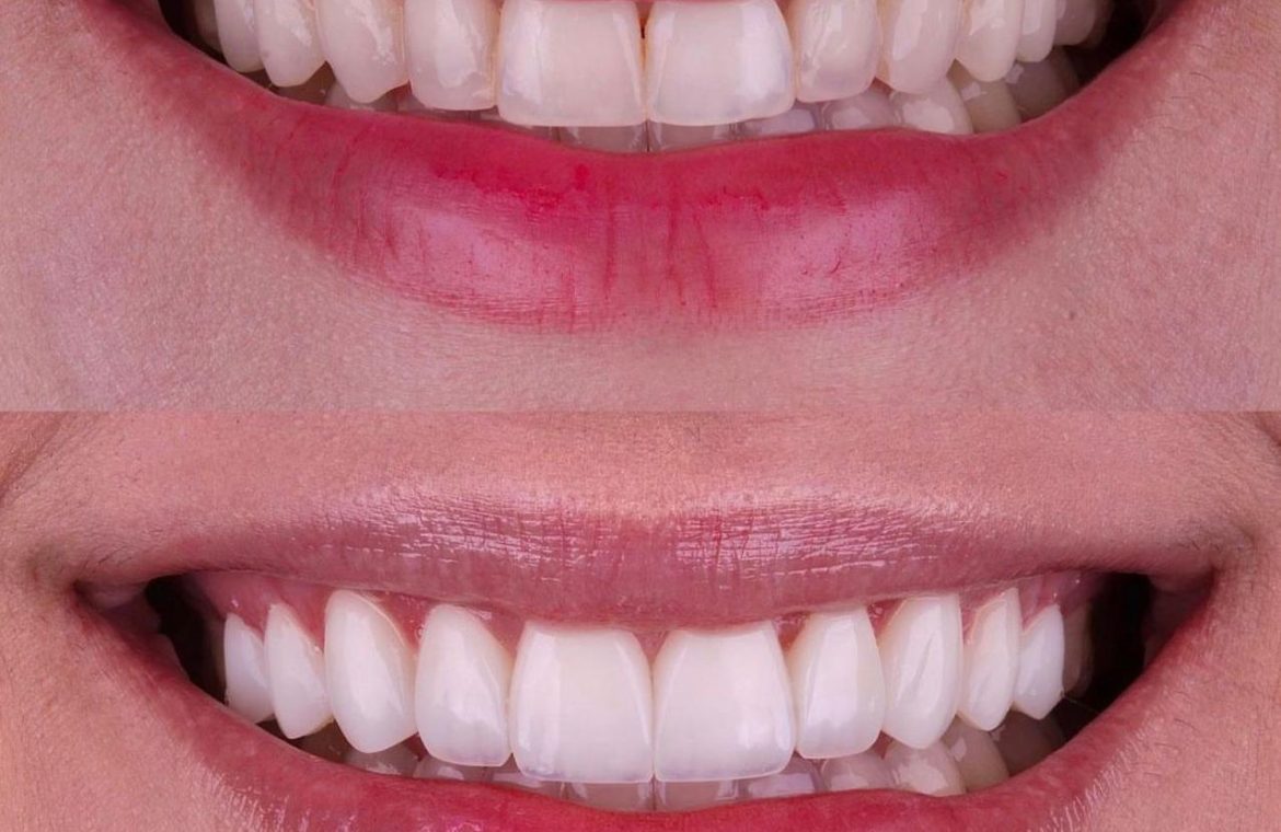 3 Facetas em resinas