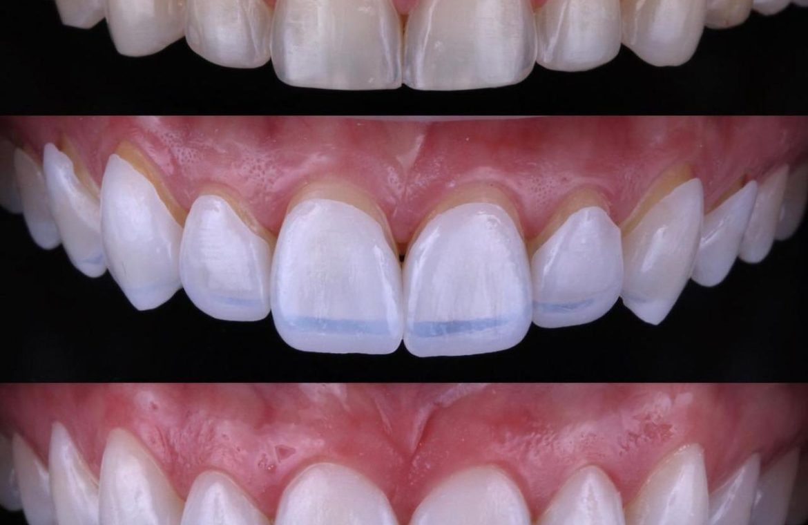 Facetas cerâmicas - sequência