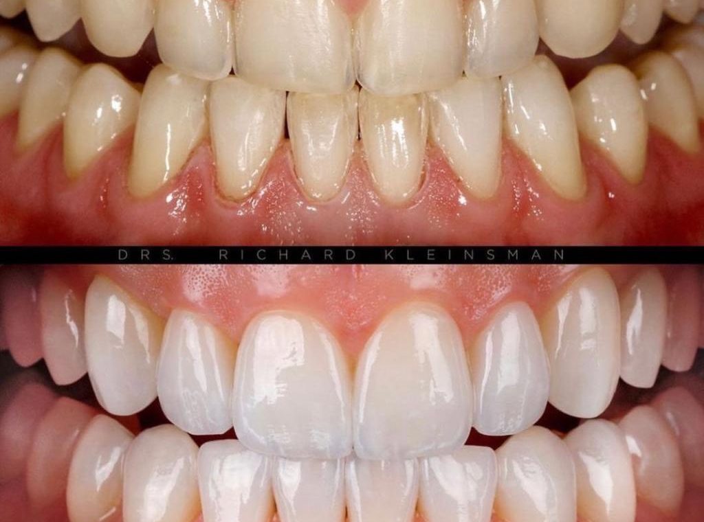 Facetas em cerâmica