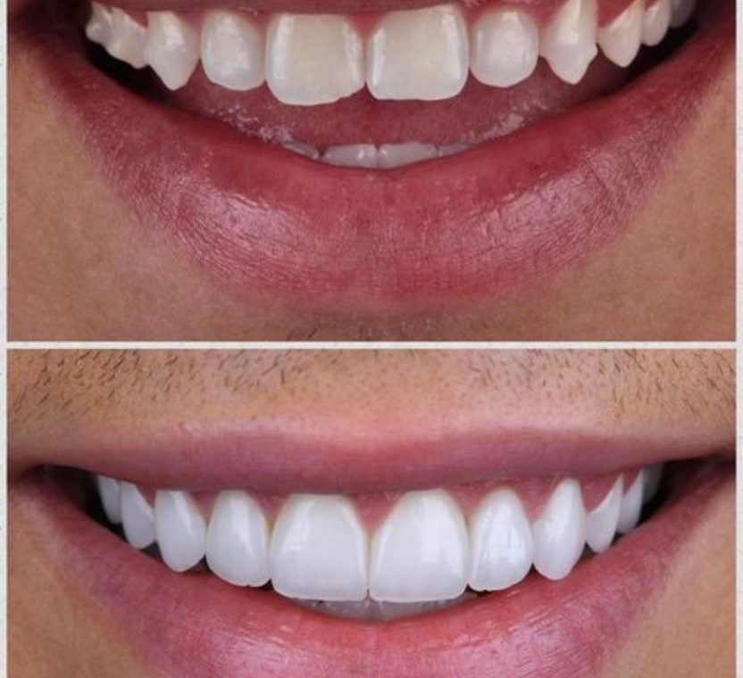 Facetas em resina - 2022