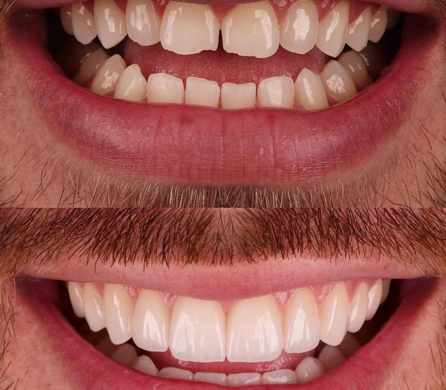 Facetas em resina - início e final - caso clínico de 2023